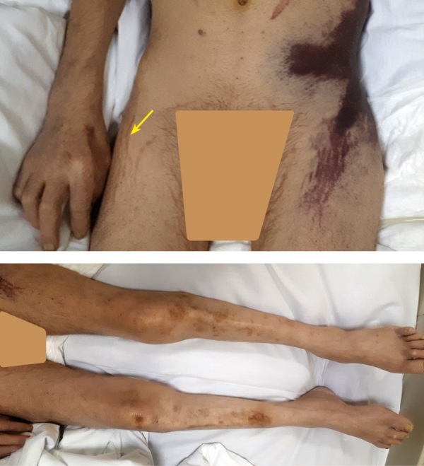 [A unique case of severe ACTH-dependent Cushing's syndrome due to ectopic corticotropin production by medullary thyroid carcinoma].