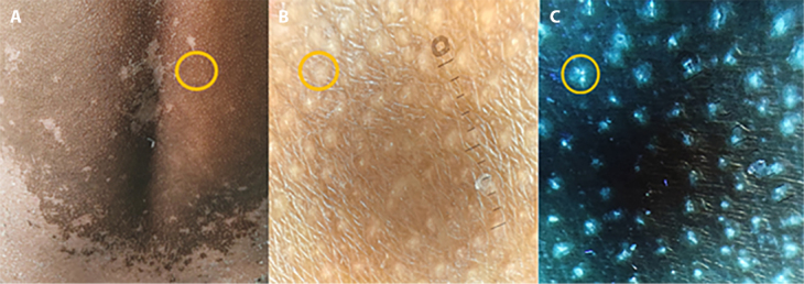 Are Blue Straggler Stars a Hidden Clue? Intriguing Discovery in Pityriasis Rubra Pilaris Under UV-Induced Fluorescence Dermoscopy.