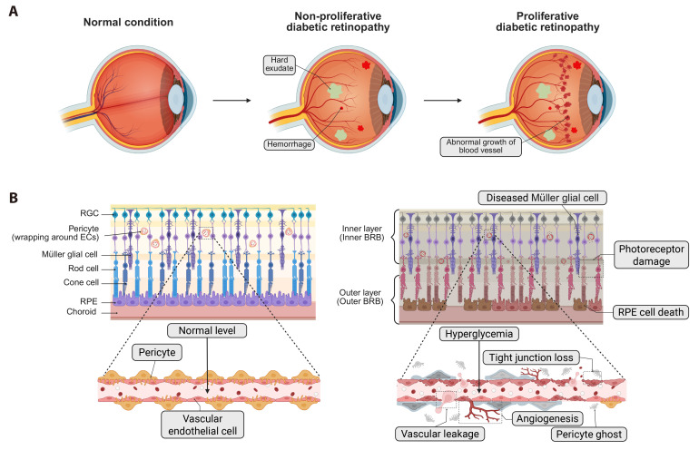 Emerging role of circular RNAs in diabetic retinopathy.
