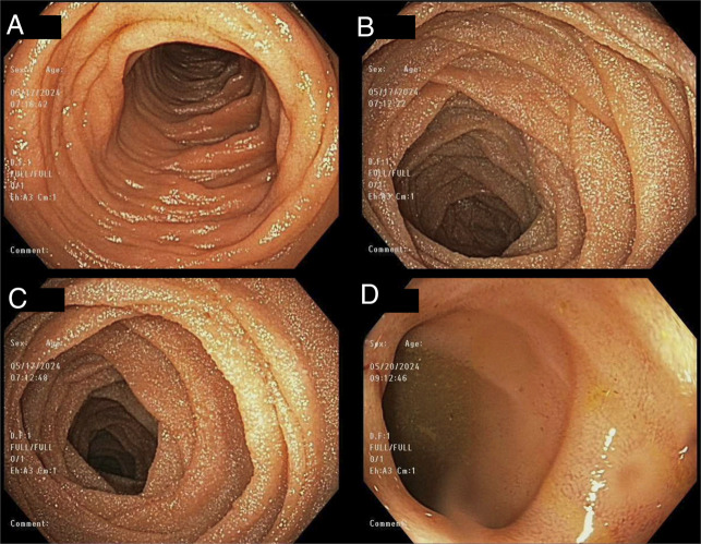 Elusive Edematous Primary Intestinal Lymphangiectasia in an Adult Patient Presenting With New Onset of Protein-Losing Enteropathy.
