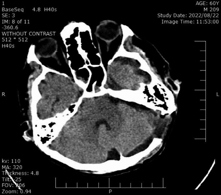 An overview of definition and approaches to jugular fossa tumors.