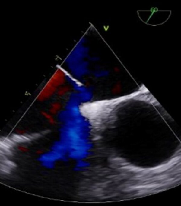 Migration of atrial septal occluder device to the thoracic aorta: case report.