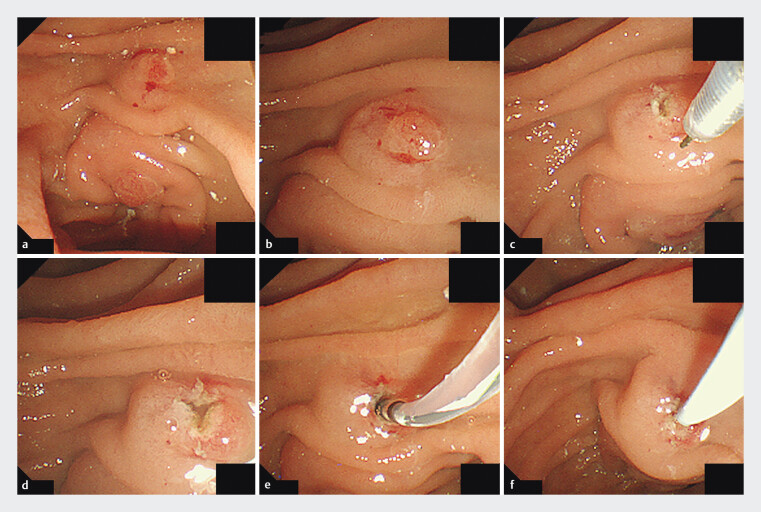 Minor papilla approach improves technical success of nasopancreatic drainage-based pancreatic juice cytology for early pancreatic cancer diagnosis.