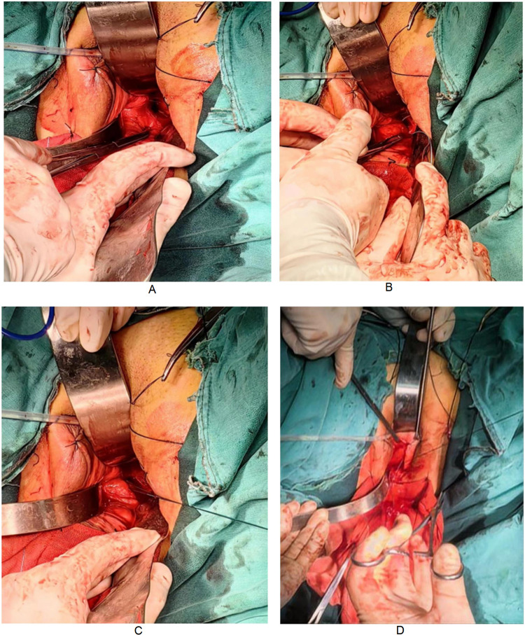 Application of an Intestinal Spatula in Optimizing a Sacrospinous Ligament Suspension.