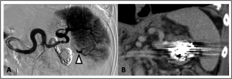 Safety and effectiveness of endovascular treatment of splenic artery aneurysms: a single centre experience.