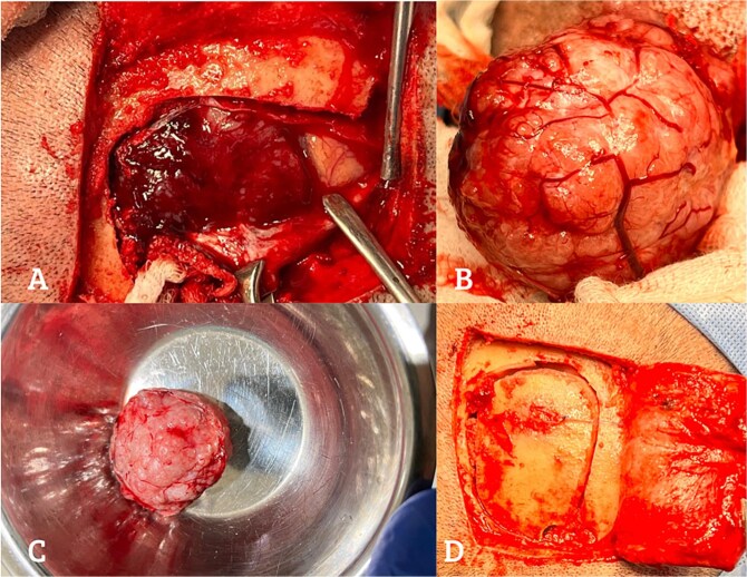 Seamless meningioma resection in a patient with coexisting myoclonic epilepsy and sporadic Pick's disease.