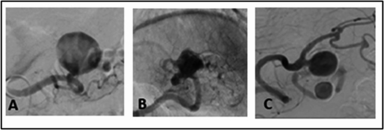 Safety and effectiveness of endovascular treatment of splenic artery aneurysms: a single centre experience.