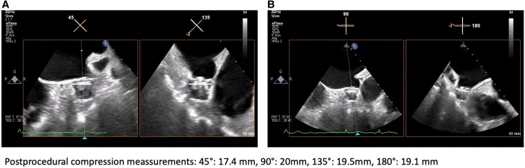 Streamlined concomitant pulse field ablation-based pulmonary vein isolation and left atrial appendage occlusion via a single venous access approach: a case report.