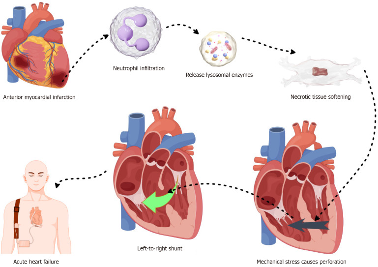Acute myocardial infarction with ventricular septal rupture: Clinical characteristics, prognosis factors, and treatment strategies.