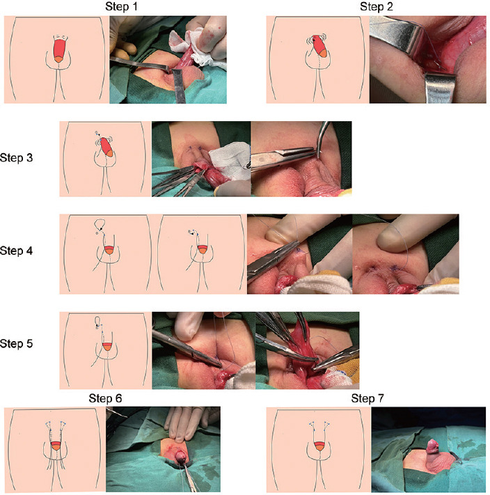 Observation on the therapeutic effect of a modified Devine procedure with subcutaneous sliding fixation method for concealed penis.