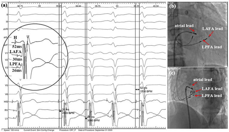 Benefits of Simultaneous Pacing Left Anterior/Posterior Fascicular Areas Combined with Atrioventricular Node Ablation in a Persistent Atrial Fibrillation Patient with Heart Failure: A Case Report.