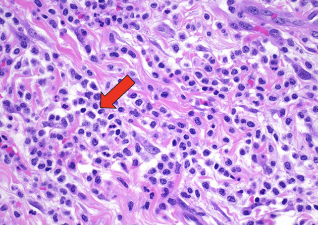 A Heart of Myeloid: Extramedullary Chronic Myelomonocytic Leukemia-2 Presenting as a Myeloid Sarcoma of the Pericardium Causing Recurrent Pericardial Effusions.