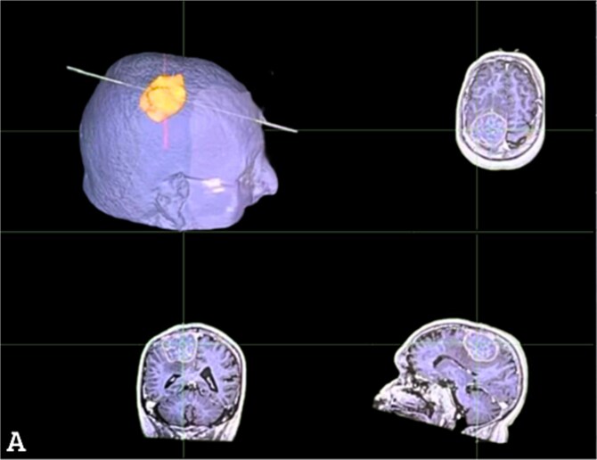 Seamless meningioma resection in a patient with coexisting myoclonic epilepsy and sporadic Pick's disease.