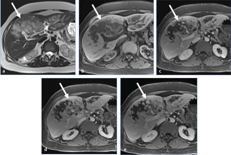 Tumor-like conditions that mimic liver tumors