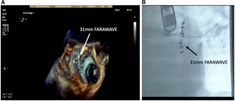 Streamlined concomitant pulse field ablation-based pulmonary vein isolation and left atrial appendage occlusion via a single venous access approach: a case report.