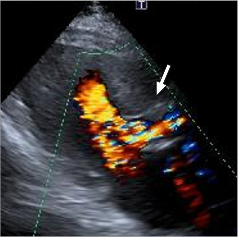 Early Structural Valve Deterioration and Cusp Tear Leading to Acute Heart Failure in a Second-Generation Trifecta Glide Technology Heart Valve.