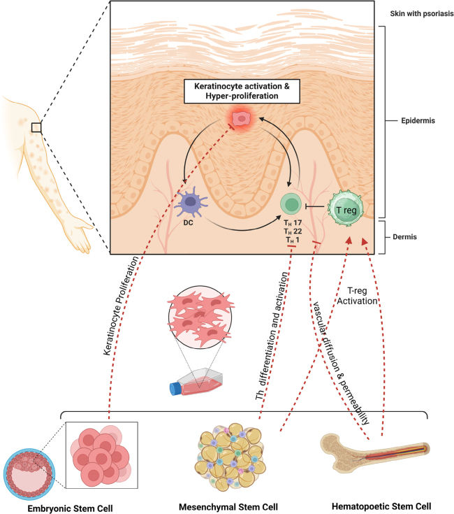Stem Cell Therapy: A New Approach and Effective Treatment for Psoriasis.