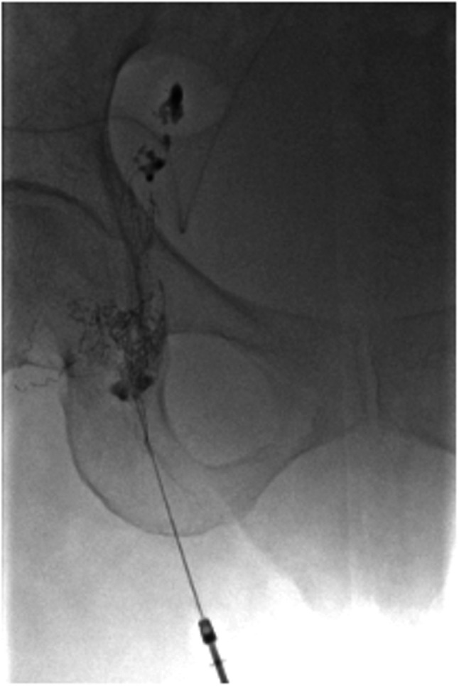 Lymph Cyst After Robotic-assisted Lateral Lymph Node Dissection for Rectal Cancer Treated With Lymphangiography: A Case Report.