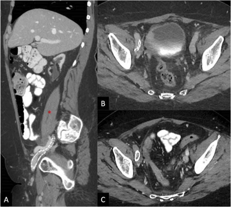 Iliac Artery Occlusion Following Iliac Vein Recanalization and Stenting in Two Patients.
