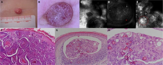 In Vivo Reflectance Confocal Microscopy for Detecting Cutaneous Metastasis in Breast Cancer.