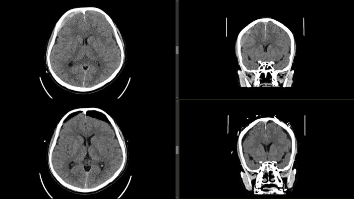 Development of chronic subdural haematoma from mild head injury: A case report and review of current Malaysian guidelines on traumatic brain injury.