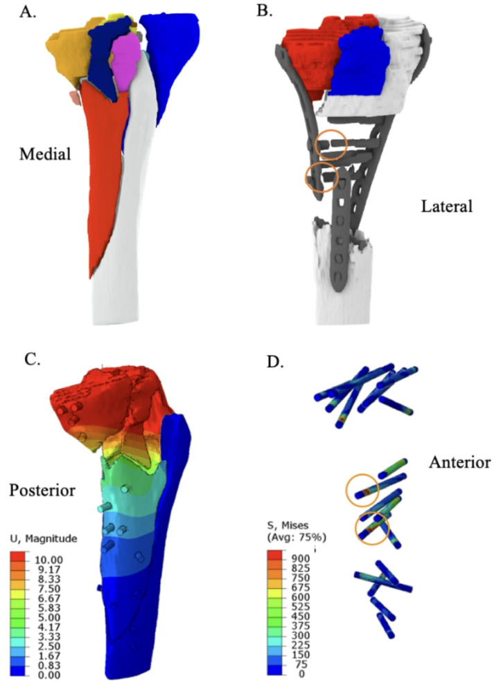 Segmentation and finite element analysis in orthopaedic trauma.
