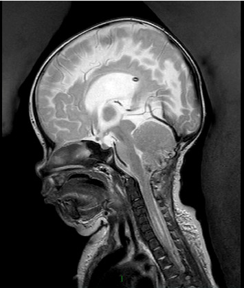 Profound Near Fatal Respiratory Dysfunction in a Neonate With Meningomyelocele: A Narrative With Neurosurgical Lessons.