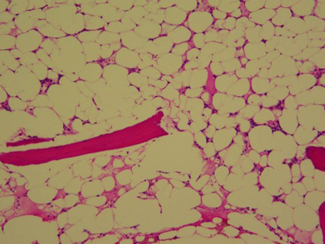 Haplo-hematopoietic stem cell transplantation and immunoradiotherapy for severe aplastic anemia complicated with nasopharyngeal carcinoma: A case report.