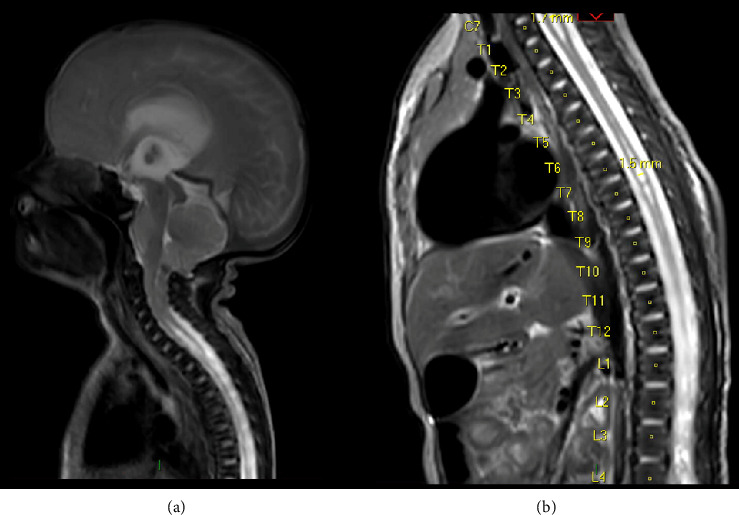 Profound Near Fatal Respiratory Dysfunction in a Neonate With Meningomyelocele: A Narrative With Neurosurgical Lessons.