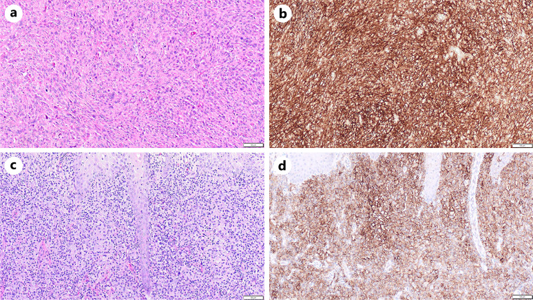 PDL1 Expression and Outcomes in Histiocytic Neoplasms.