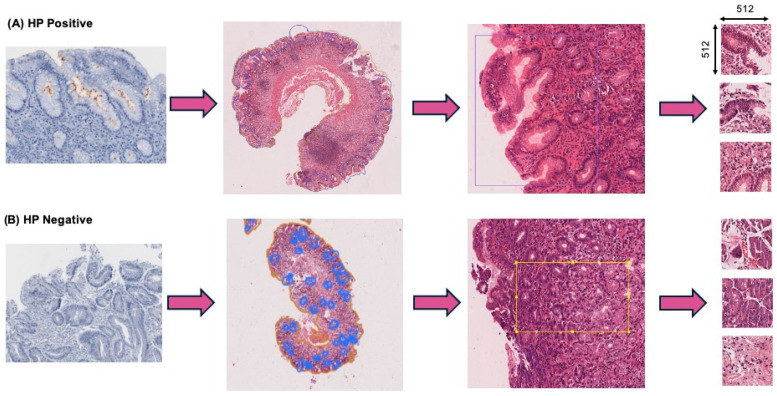 Detection of <i>Helicobacter pylori</i> Infection in Histopathological Gastric Biopsies Using Deep Learning Models.