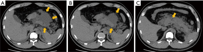 Clinical-CT mismatch in acute pancreatitis: a new concept and report of two cases.