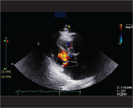 Navigating the Complexities of Mitral Valve Clipping: Early Severe Mitral Valve Stenosis After Mitral Valve Clipping.