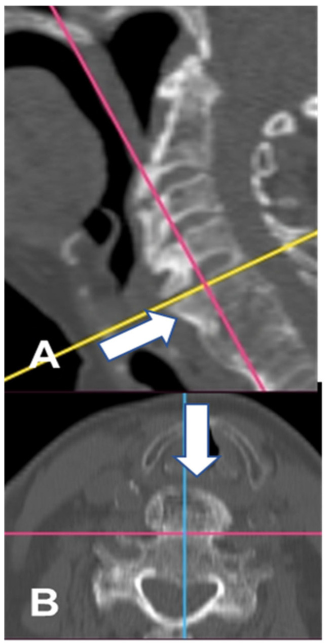 Lifesaving Treatment for DISH Syndrome in the Tenth Decade of Patient's Life.