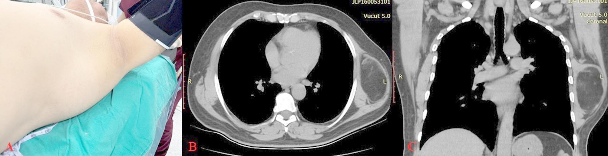 Thoracic outlet syndrome induced by extrathoracic giant lipoma: first case in the literature due to the atypical location.