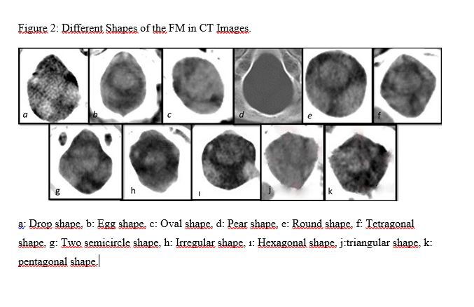 A new golden ratio for foramen magnum in pre- and post-adolescent children.