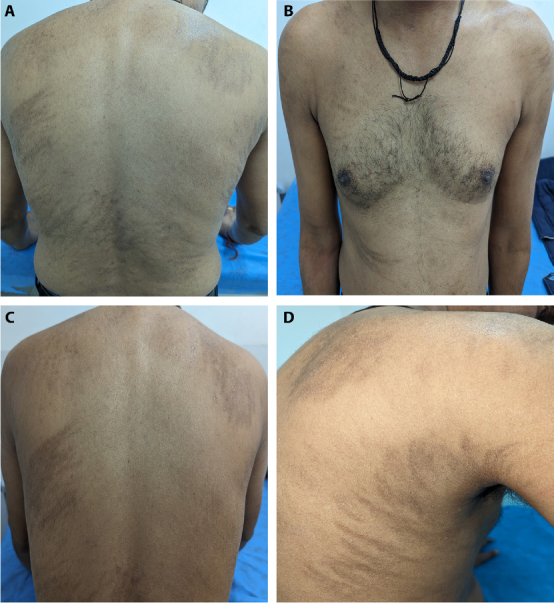 Flagellate Rash in Chikungunya: A Comprehensive Review of Dermatological Manifestations.