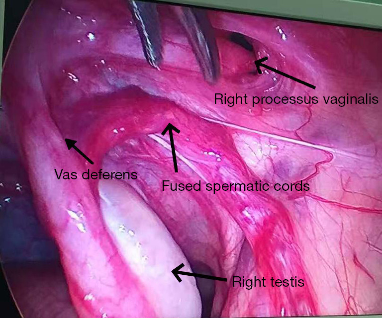 Laparoscopic management of transverse testicular ectopia with spermatic cord fusion: a case report.