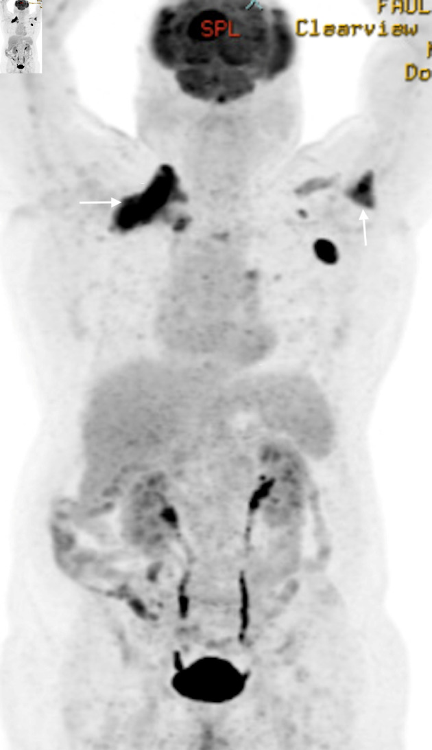Secondary Central Nervous System Lymphoma Involving Meninges: A Rare Case Report and a Comprehensive Review of Peripheral T-Cell Lymphoma, Not Otherwise Specified.