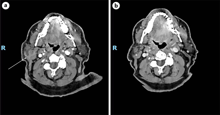 PDL1 Expression and Outcomes in Histiocytic Neoplasms.