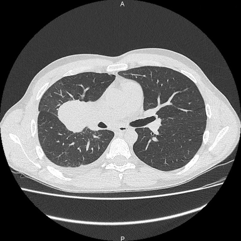 A case report and literature review of a pathologic complete response to alectinib in <i>ALK</i>-positive stage IV non-small cell lung cancer.