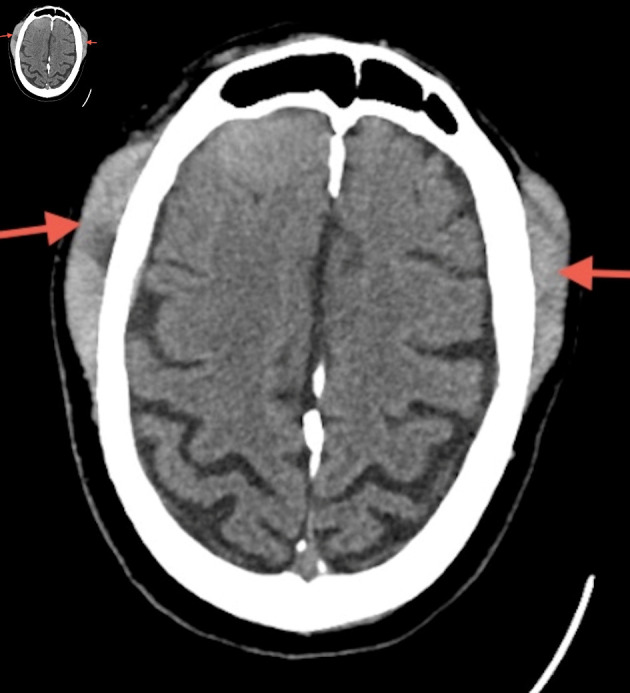 Secondary Central Nervous System Lymphoma Involving Meninges: A Rare Case Report and a Comprehensive Review of Peripheral T-Cell Lymphoma, Not Otherwise Specified.