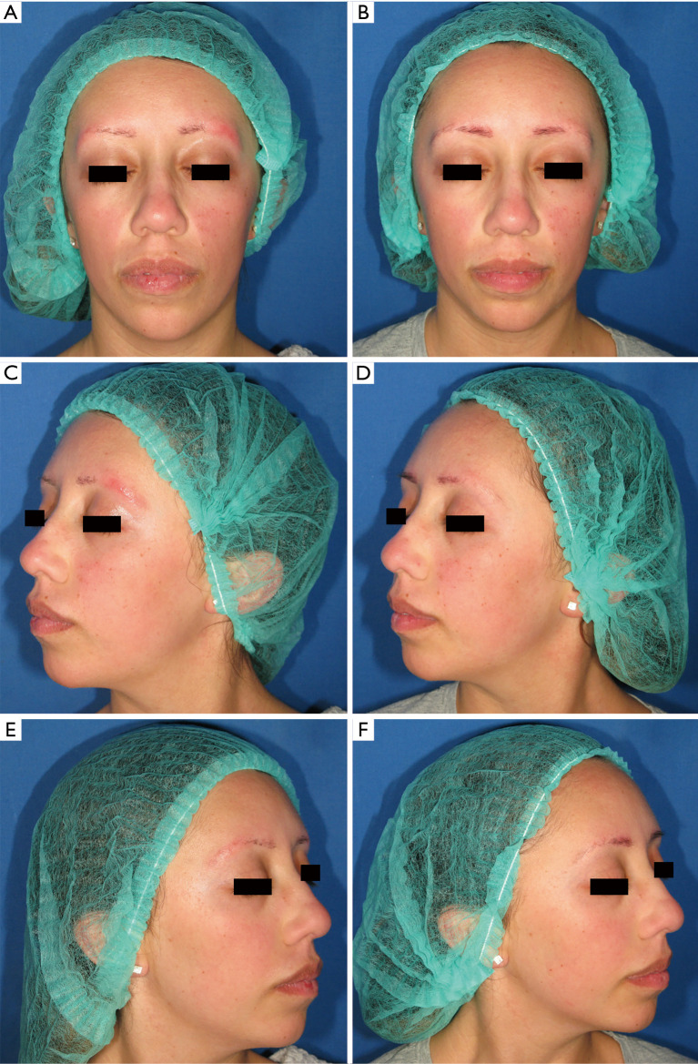 Successful treatment of ulerythema ophryogenes with pulsed dye laser: a case report.