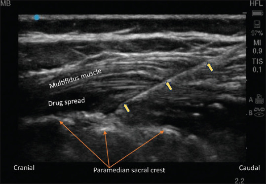 Unilateral sacral erector spinae plane block for lower limb surgery in children.