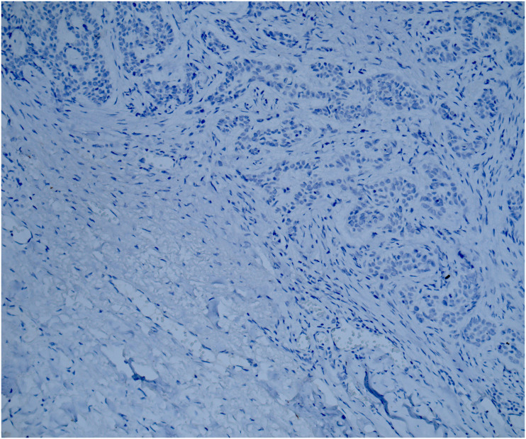 Relationship between androgen receptor and epidermal growth factor receptor determines aggressive behavior of cutaneous basal cell carcinoma.
