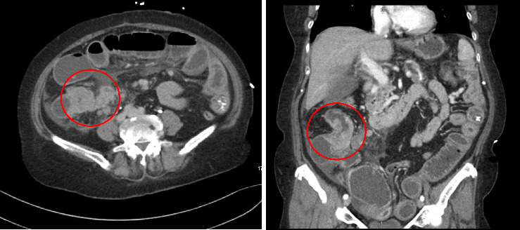 Rare Case of Duodenal Metastasis From Colon Cancer: Review of Literature and Insights on Novel Therapies.