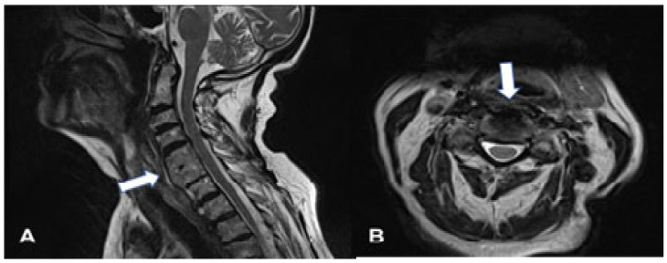 Lifesaving Treatment for DISH Syndrome in the Tenth Decade of Patient's Life.