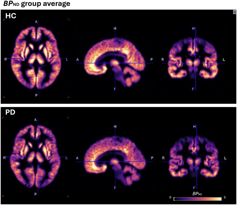 [<sup>18</sup>F]SynVest-1 PET imaging in people with Parkinson's disease.