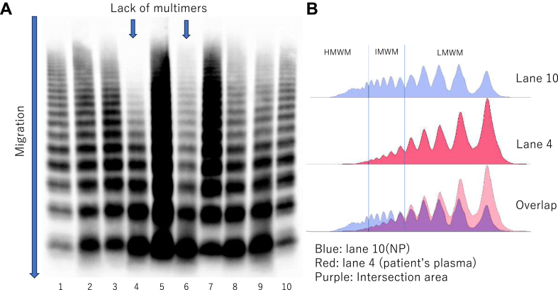Prognostic relevance of early clinical and laboratory findings in immune-mediated thrombotic thrombocytopenic purpura.