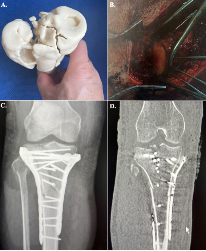 Segmentation and finite element analysis in orthopaedic trauma.